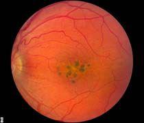 Macula of affected person