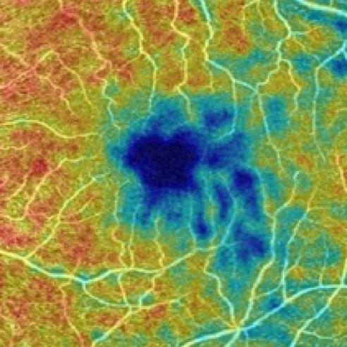 Retinal image of person with Alzheimer's disease 
