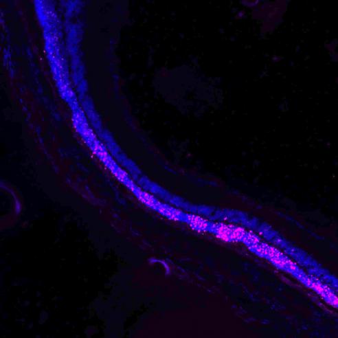 Damaged, untreated retina