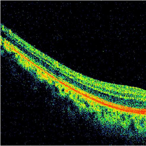 OCT image of fovea