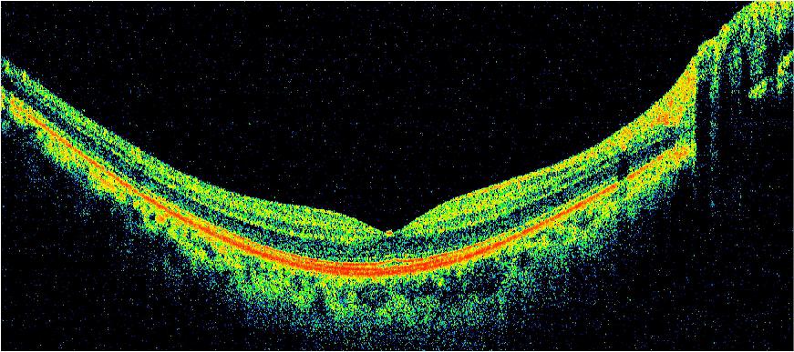 Image of fovea