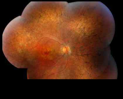 composite of human retina