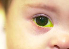 Infant wearing contact lens.jpg