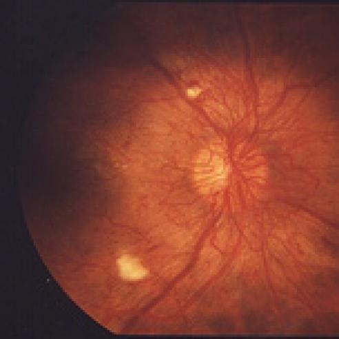 Diabetic retinopathy