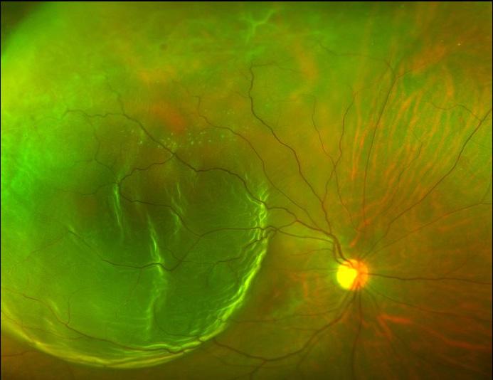 Retinal detachment 