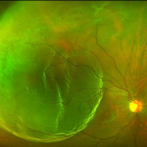 fundus photo of retinal detachment 