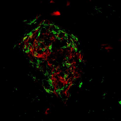 Choroidal neovascular lesion with associated blood vessels and immune cells 