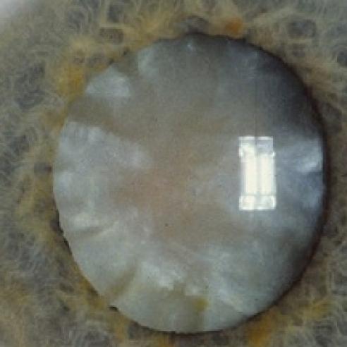 congenital cataract