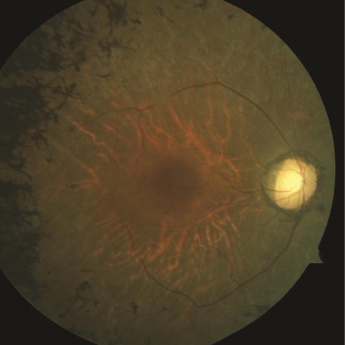 Retina of a person with retinitis pigmentosa 